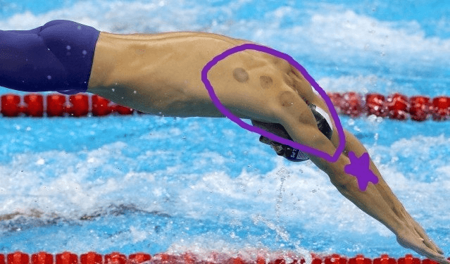 Michael Phelps cupping